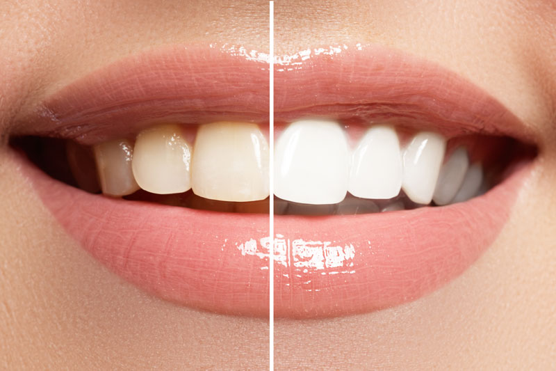 Unlock Your Confidence: Transformative Impact of Cosmetic Dentistry Makeover